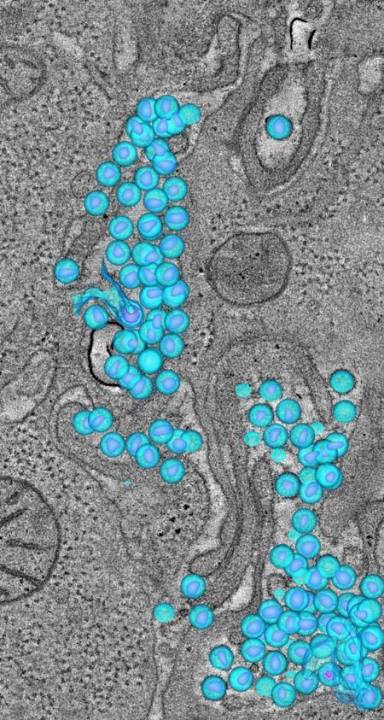 Uma reconstrução tomográfica do cólon mostra a localização de grandes conjuntos de HIV-1, as partículas de vírus (em azul) localizadas nos espaços entre as células adjacentes. Os objetos roxos dentro de cada esfera representam os núcleos cônicos que são uma das características estruturais do vírus HIV. Crédito da Imagem: Mark Ladinsky/Caltech.