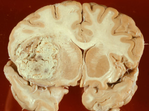 Imagem do tumor